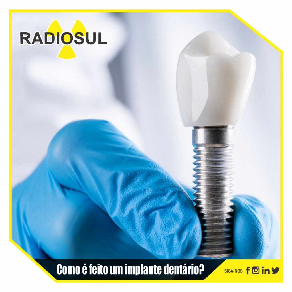 Radiosul Digital Como é Feito Um Implante Dentário 8530