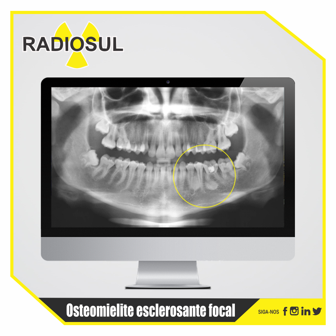 RadioSul Digital  Osteomielite esclerosante focal