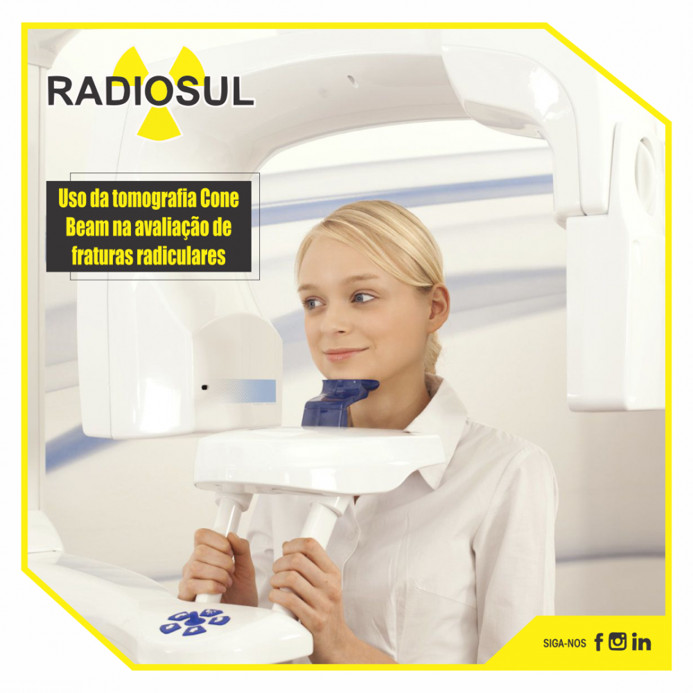 Radiosul Digital Uso Da Tomografia Cone Beam Na Avalia O De Fraturas Radiculares